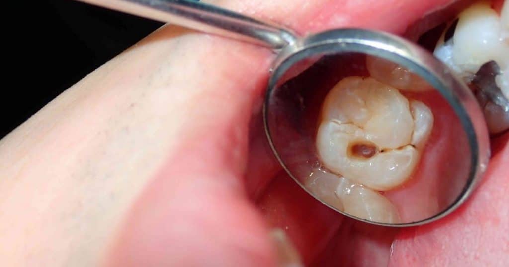 a close-up of a decayed tooth using a mirror, showing importance of preventing tooth decay.