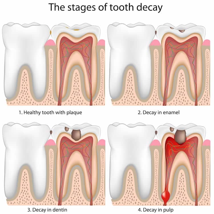 an illustration of different stages of tooth decay.