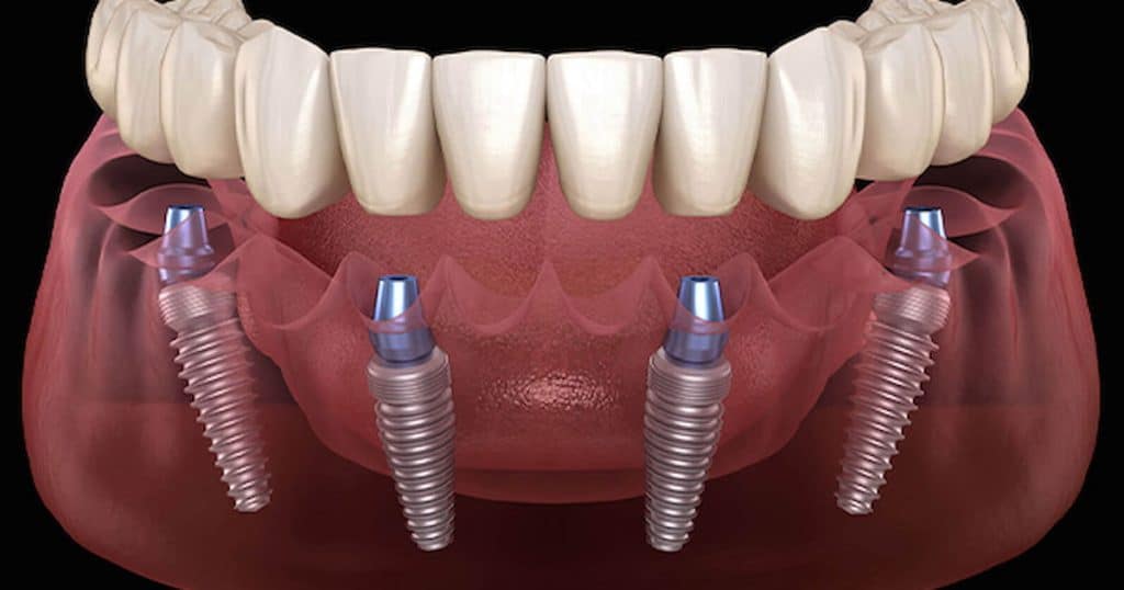 Transform Your Smile and Life with All-on-4 Dental Implants