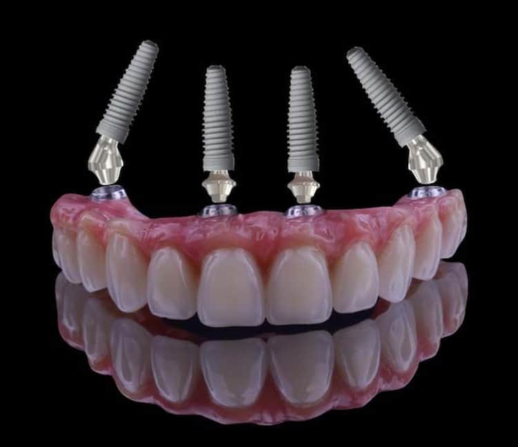 a set of upper jaw teeth with 4 implants connected to it.