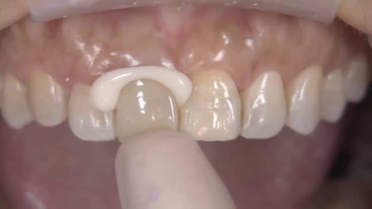 a dental crown being cemented to a tooth.