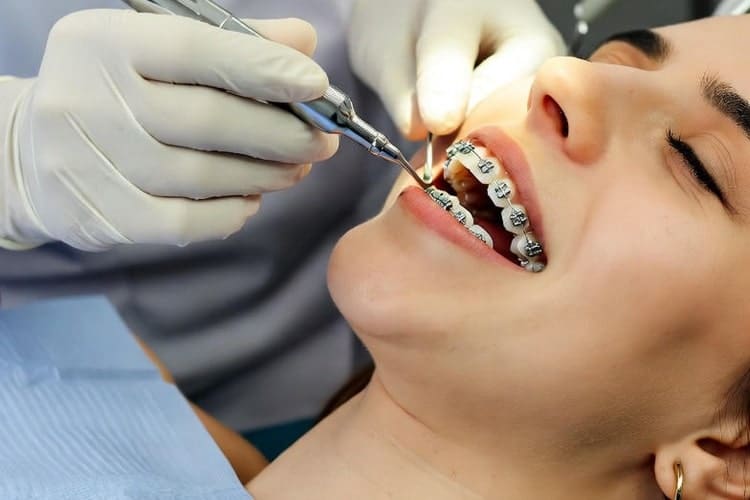 removing braces by dentist