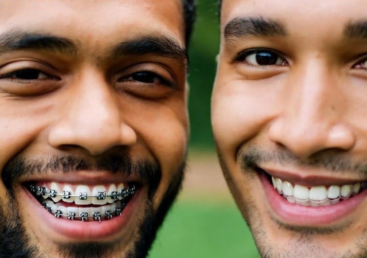 Different Types of Braces