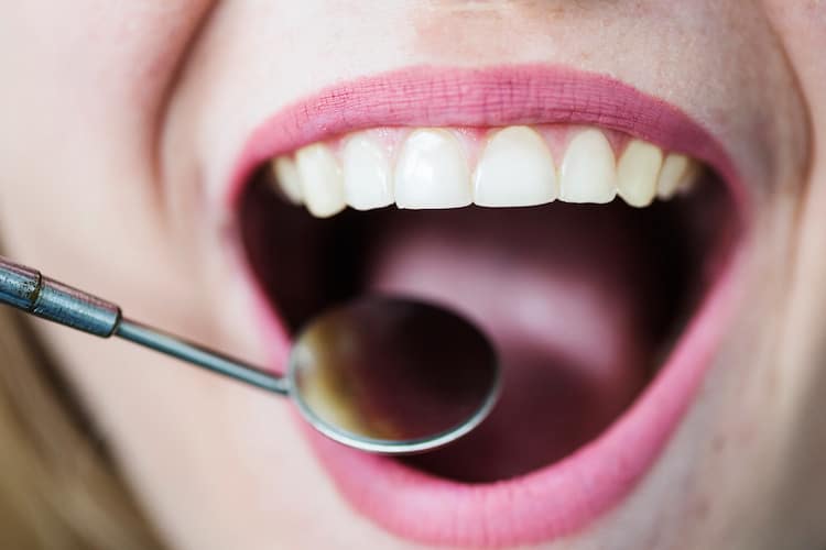 A close-up of a person's open mouth with white teeth, being examined with a dental mirror during a procedure focused on front tooth filling and whitening.