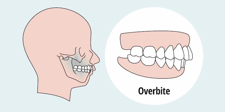 an illustration of anatomy of overbite teeth 