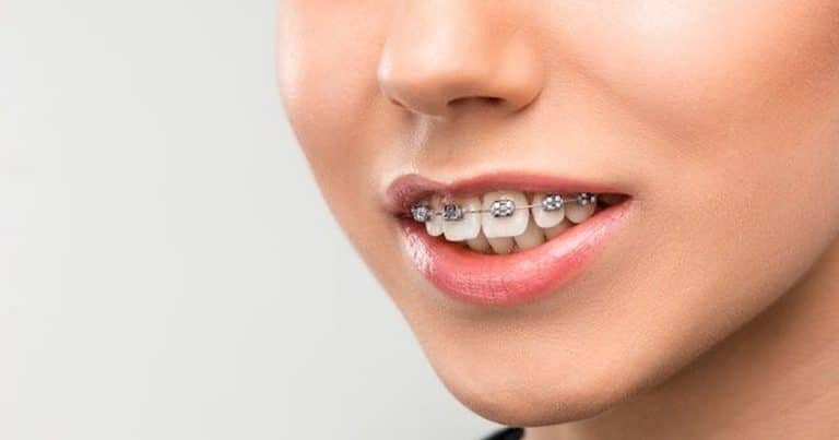 a woman with overbite teeth is wearing braces.