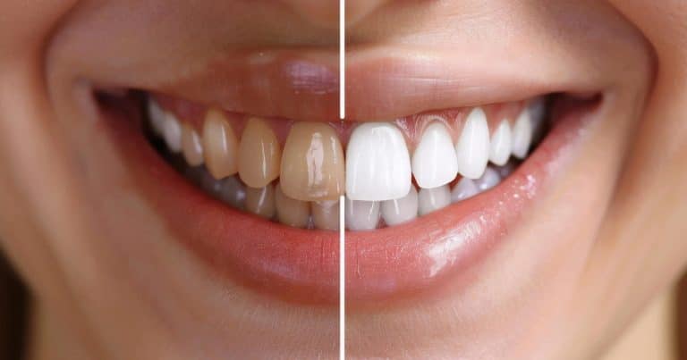 Before and after of the best way to whiten fillings on front teeth.