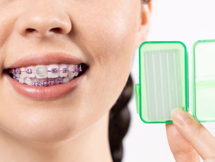 using Orthodontic Wax and Chewies for Invisalign Pain  