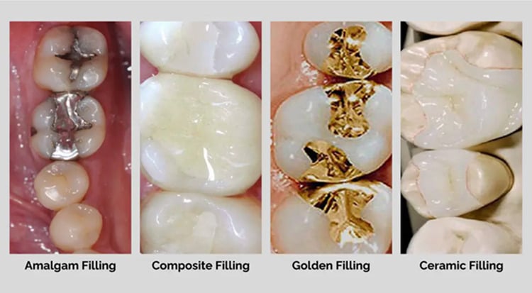 different types of fillings