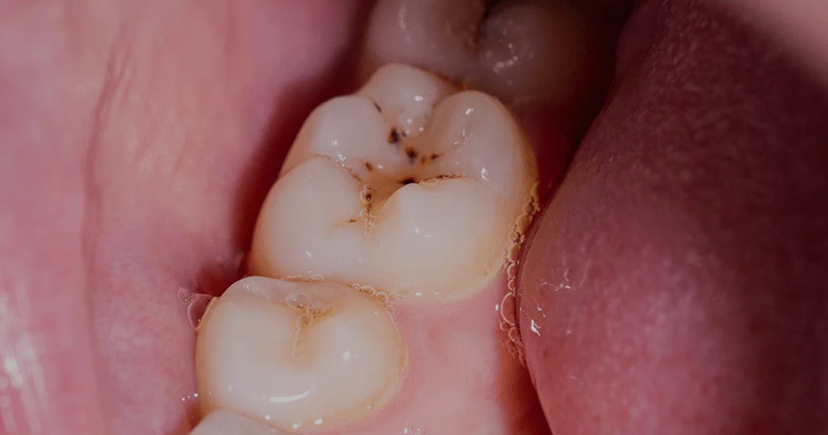 Black Spots on Your Teeth: Why They Appear and How to Treat Them