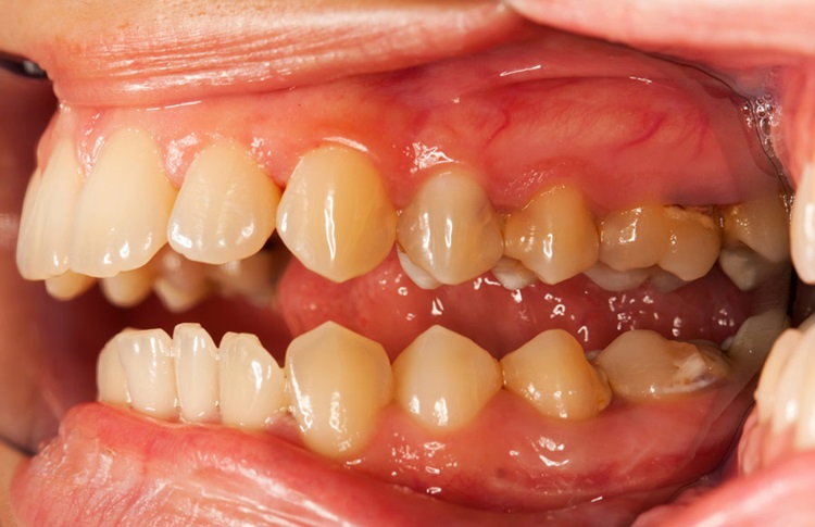 Tartar Buildup causing black spots on teeth