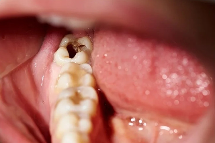 Tooth Decay or Cavity