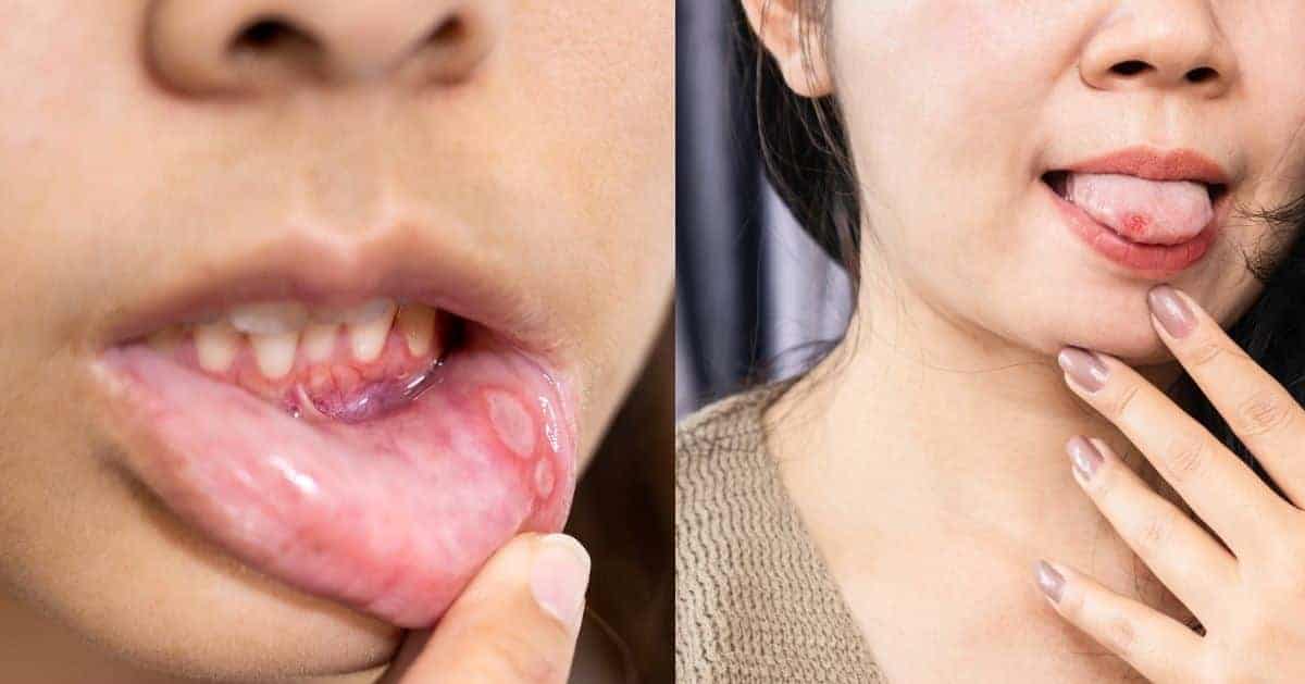 Canker Sores vs Cold Sores: How to Tell the Difference