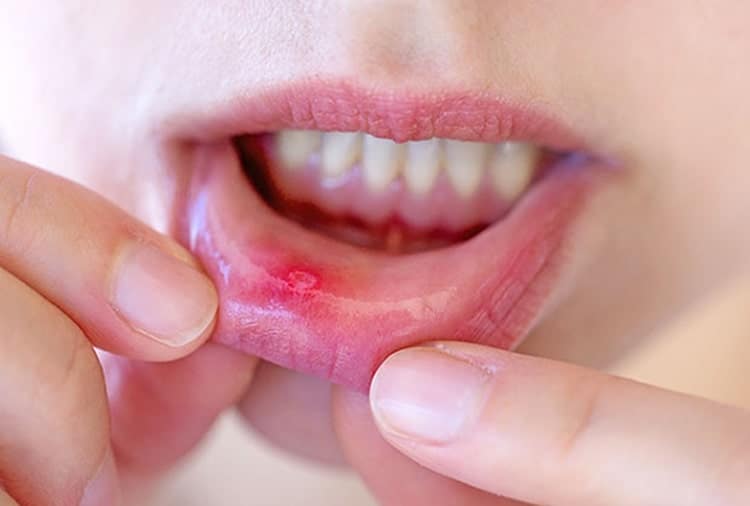location of canker sores