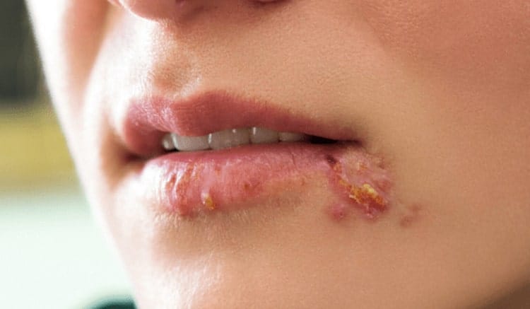 symptons of cold sores