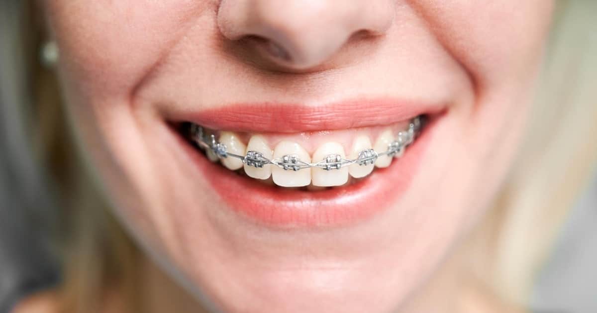 Cost of Braces in Canada: How Much to Pay in 2026 
