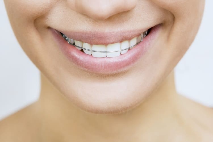 how to protect your retainer