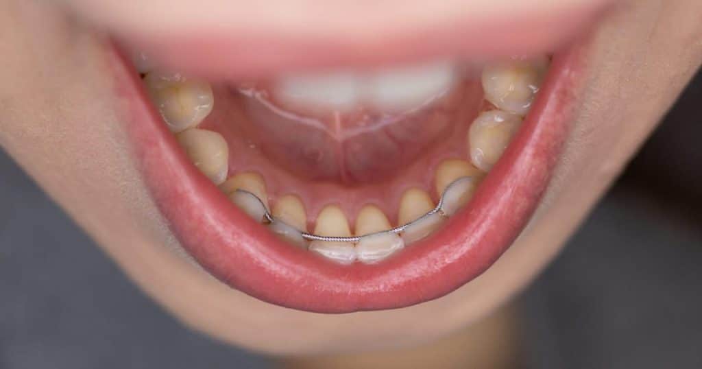 Permanent Retainer Glue Came Off