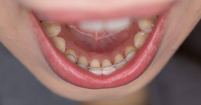 Permanent Retainer Glue Came Off