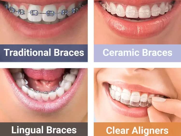 different Types of Braces
