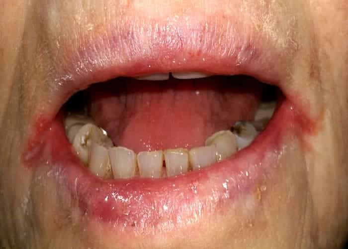 Corner-of-the-mouth Sores (Angular Cheilitis)