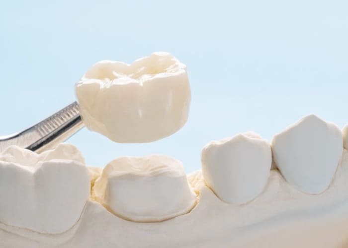 Dental Crowns 