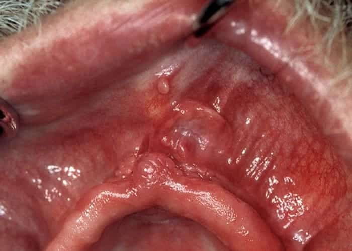 Pressure Sores from Dentures