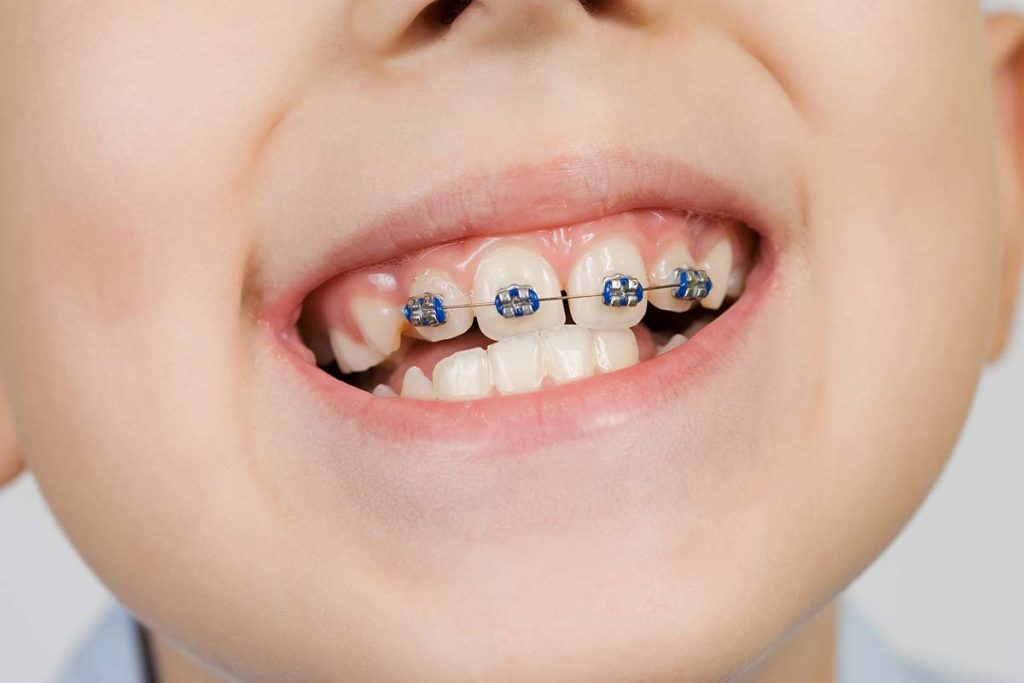 a child with Orthodontic