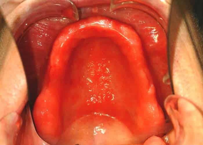 denture allergy