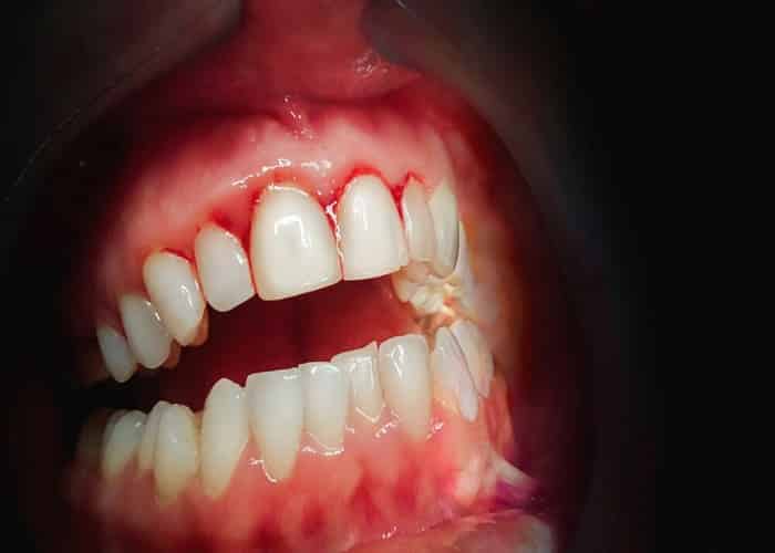 Fungal Inflammation (Denture Stomatitis)