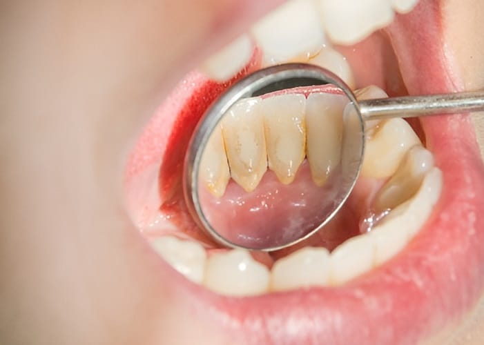 teeth that need dental cleanings
