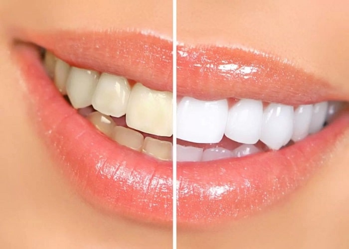 teeth whitening