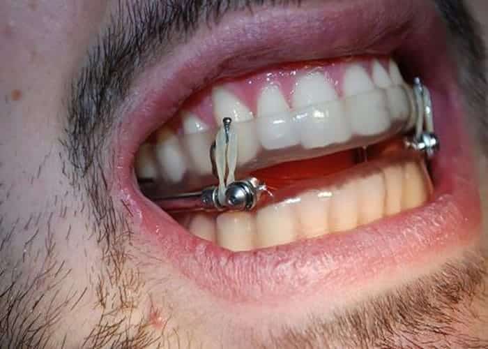 Oral Appliances in Sleep Apnea Treatment