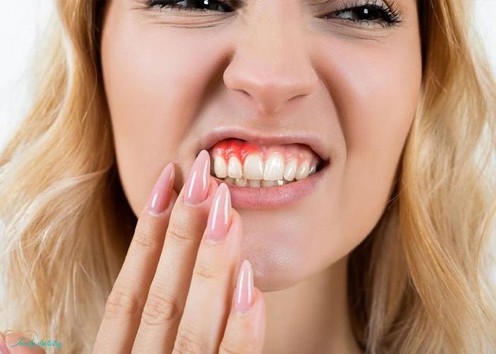Gums Swell After Tooth Extraction