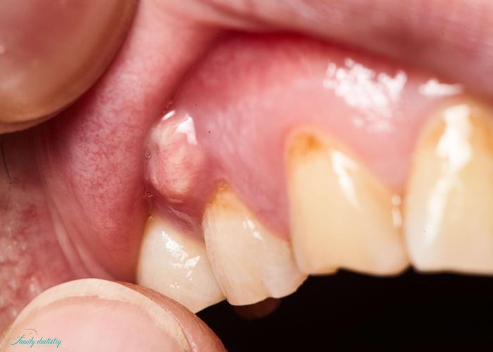 Bacterial infection after tooth extraction