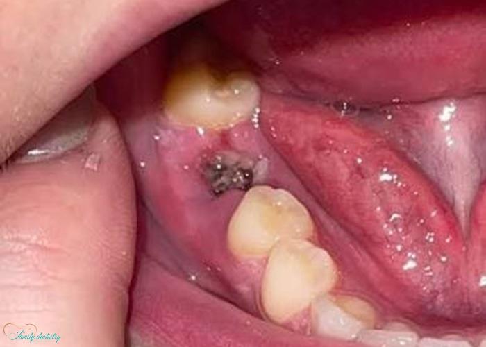 Dry socket