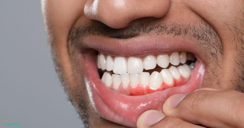 Swollen Gums After Tooth Extraction