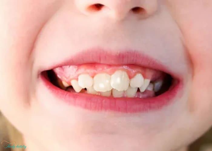 Dental Fluorosis