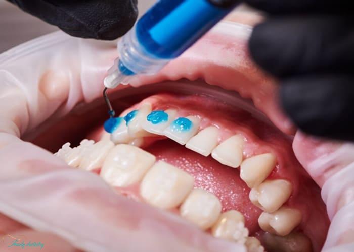 Fluoride Therapy and Enamel Strengthening