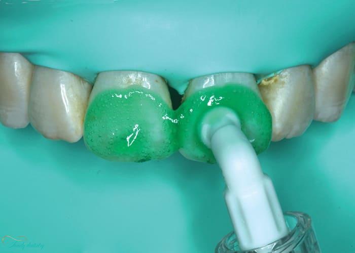Resin Infiltration
