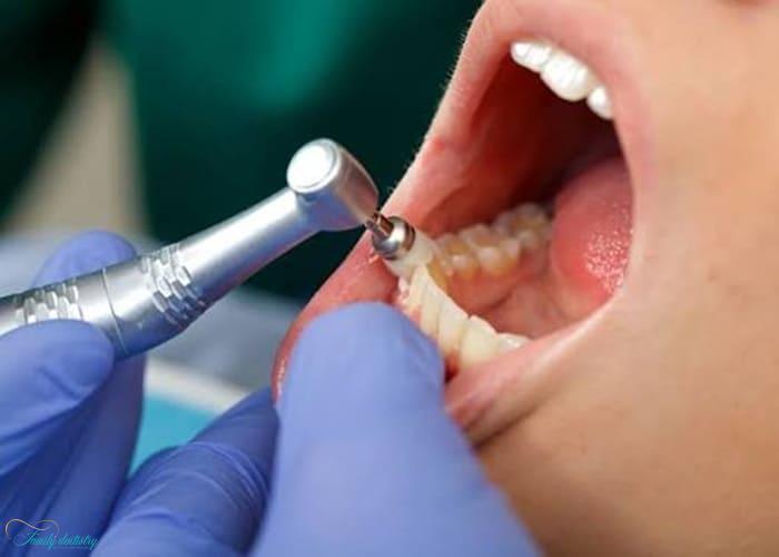 Enamel Microabrasion
