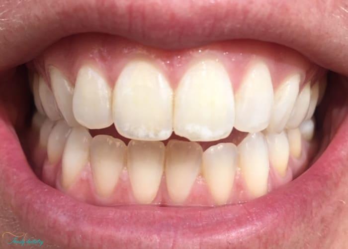 causes of white spots on teeth