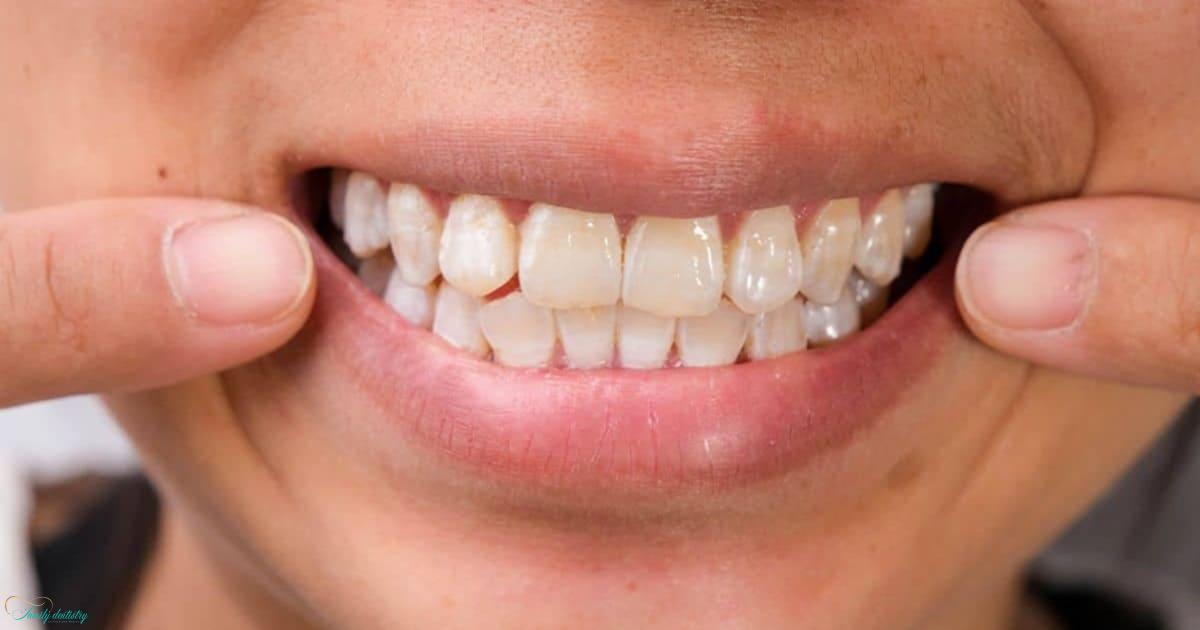 White Spots on Teeth: Causes, Treatments, and When to See a Dentist
